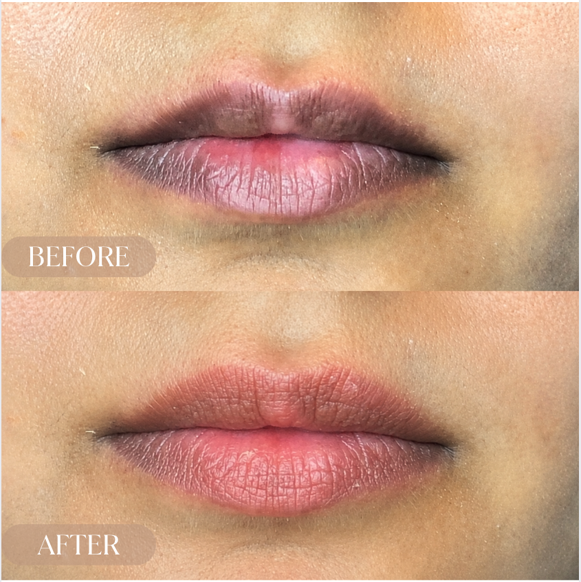 Lip blush and neutralization before and after